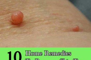 10 Home Remedies To Remove Skin Tags