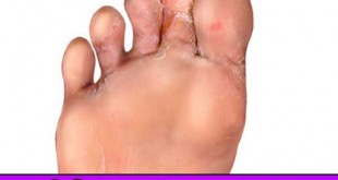 10 Natural Home Remedies for Athlete’s Foot
