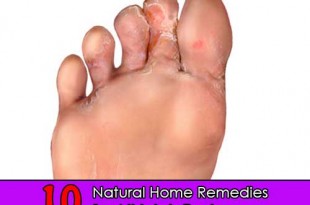 10 Natural Home Remedies for Athlete’s Foot