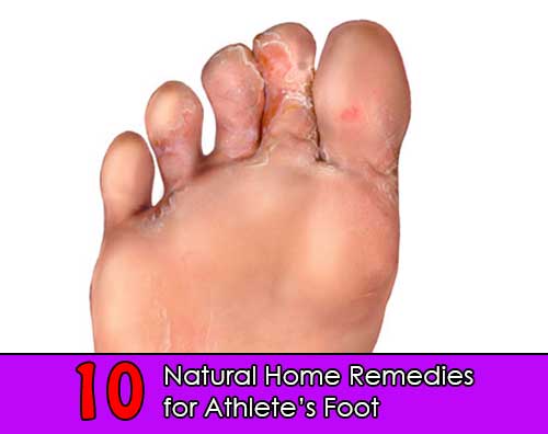 10 Natural Home Remedies for Athlete’s Foot