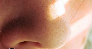 6 Simple, Affordable, and Effective Blackhead Hacks
