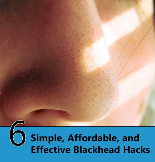 6 Simple, Affordable, and Effective Blackhead Hacks