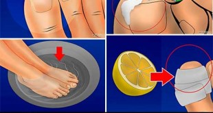 9 Home Remedies for Ingrown Toenails