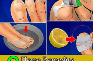 9 Home Remedies for Ingrown Toenails