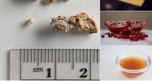 6 All Natural Kidney Stone Remedies