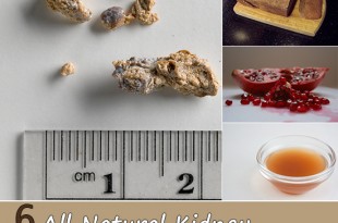 6 All Natural Kidney Stone Remedies