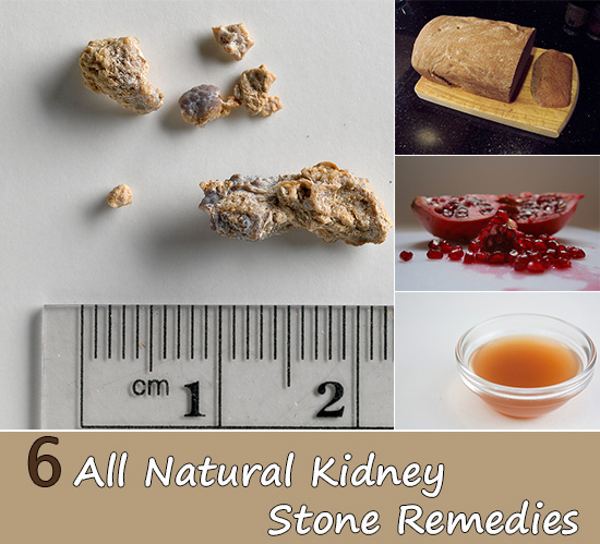 6 All Natural Kidney Stone Remedies 