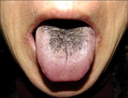  Does your tongue have black spots or is a little hairy?