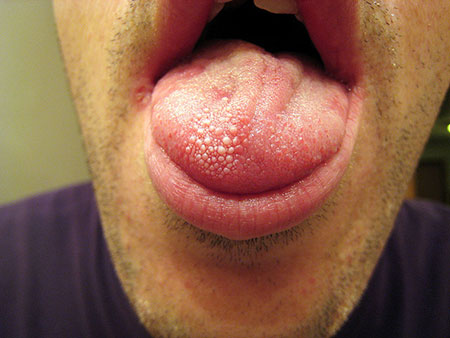 Is your tongue white or dotted with white spots