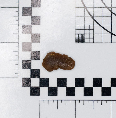 Kidney Stones