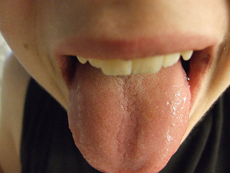  Is your tongue completely smooth and a little pale ?