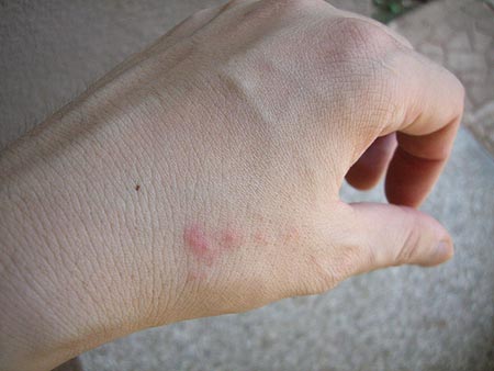 Bug Bites