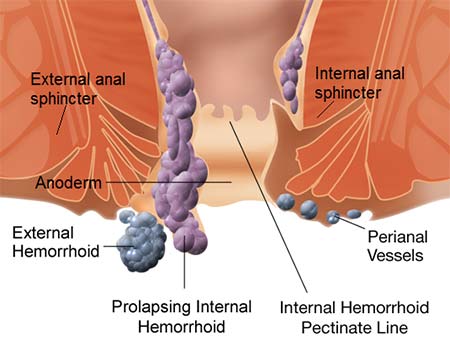 Help For Hemorrhoids