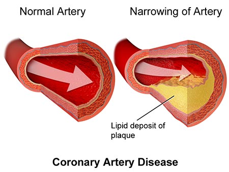 Coronary artery disease