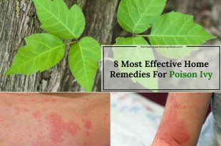 Poison Ivy Home Remedies: 8 Most Effective Remedies For Poison Ivy