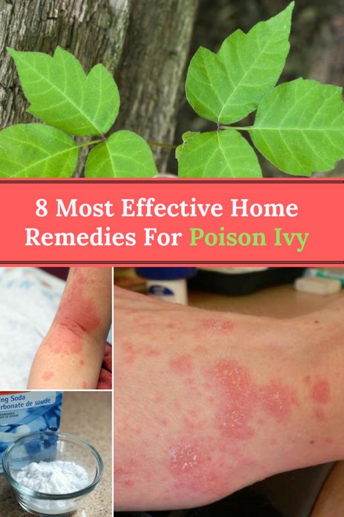 Poison Ivy Home Remedies