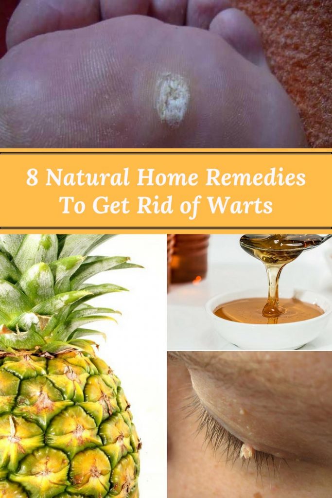 8 Natural Home Remedies To Get Rid of Warts