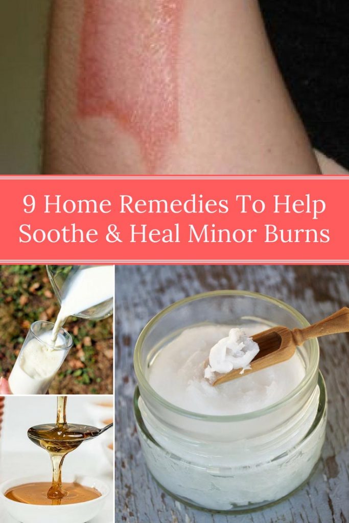 9 Home Remedies To Help Soothe & Heal Minor Burns