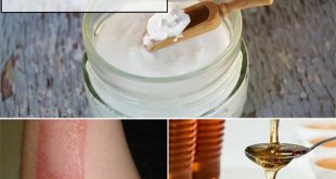9 Home Remedies To Help Soothe & Heal Minor Burns