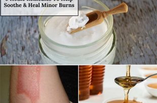 9 Home Remedies To Help Soothe & Heal Minor Burns