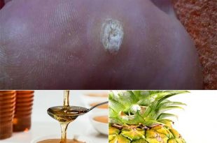 8 Natural Home Remedies To Get Rid of Warts