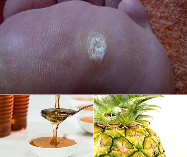 home remedies to get rid of warts on fingers