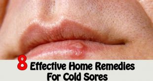 8 effective home remedies for cold sores