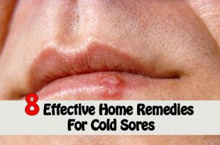8 effective home remedies for cold sores