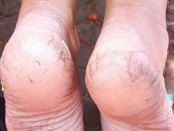 Relieve Dry Cracked Heels