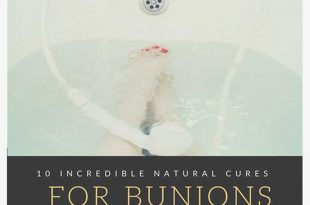 10 Incredible Natural Cures for Bunions