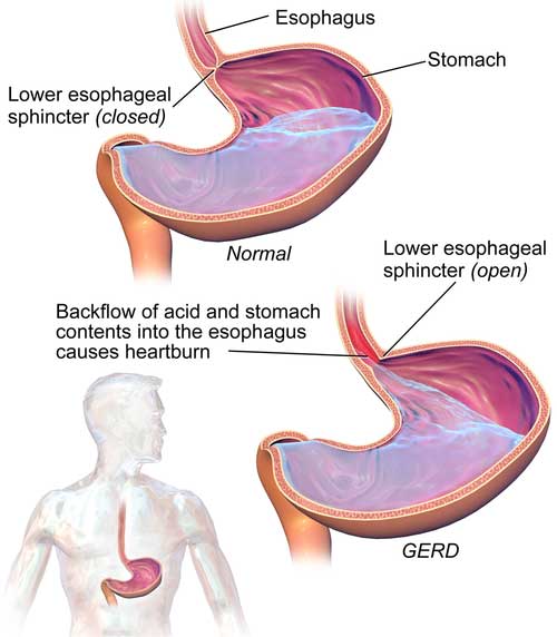 Acid Reflux