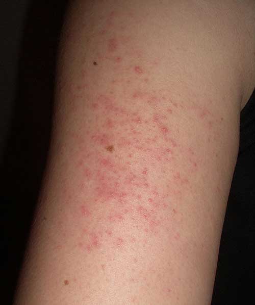 Skin Problems
