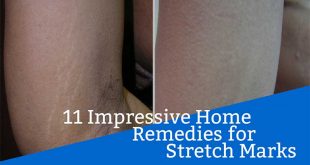 11 Impressive Home Remedies for Stretch Marks