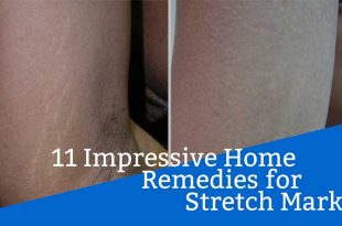 11 Impressive Home Remedies for Stretch Marks