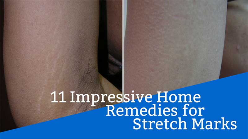 11 Impressive Home Remedies for Stretch Marks