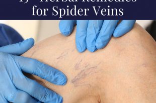 Herbal Remedies for Spider Veins