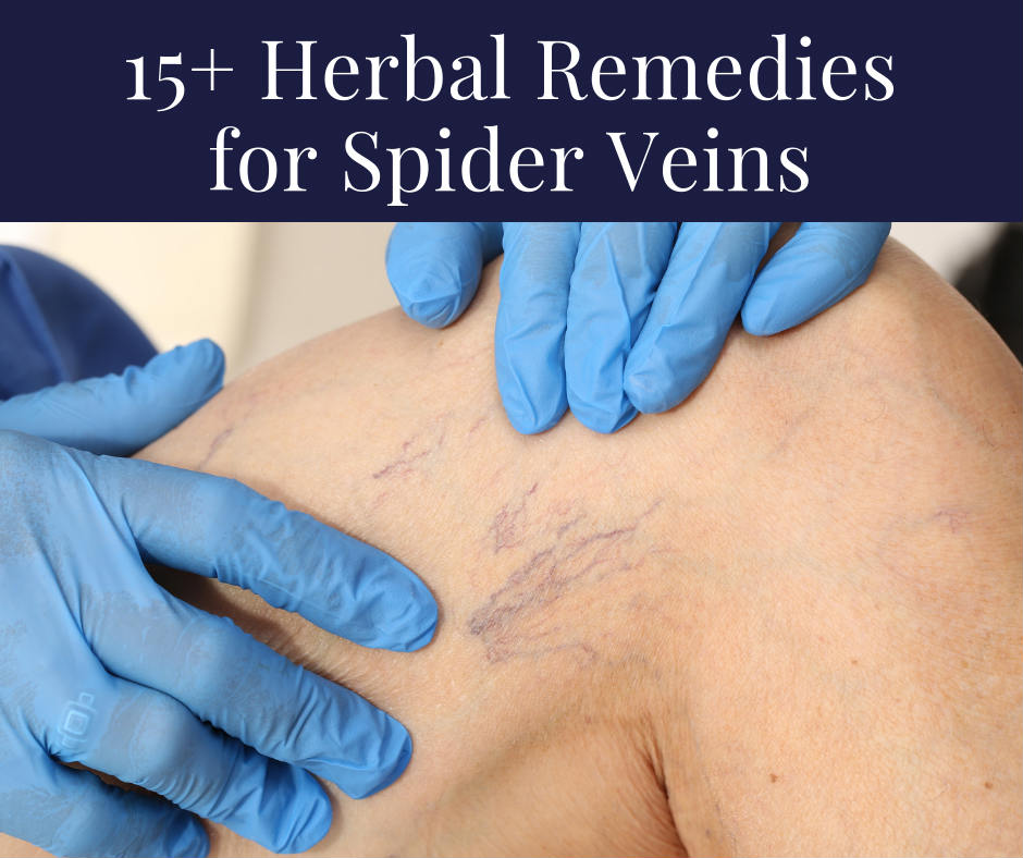  Herbal Remedies for Spider Veins