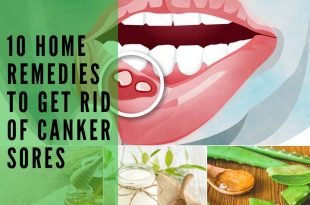 Home Remedies to Get Rid Of Canker Sores