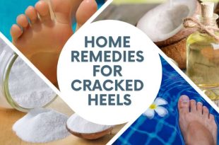 Home Remedies for Cracked Heels