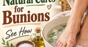10 Incredible Natural Cures for Bunions