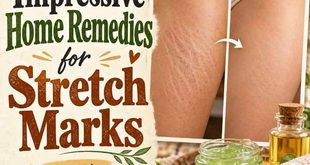 11 Impressive Home Remedies for Stretch Marks