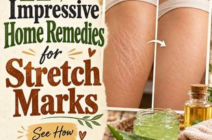 11 Impressive Home Remedies for Stretch Marks